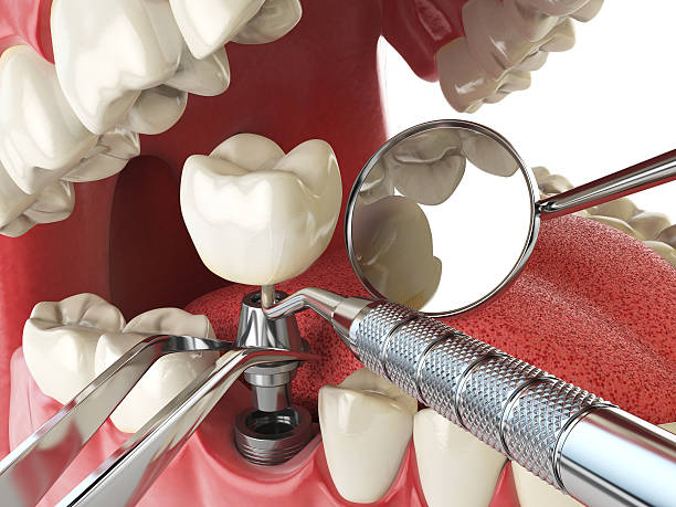 Best Urgent Tooth Repair  in Gratton, VA